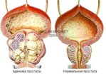 prostata_adenoma.jpg