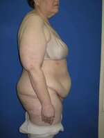 Plastic-surgery-old-age-60-years-patient.jpg